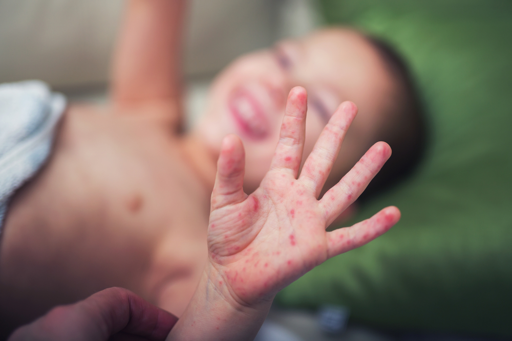 child with hand, foot, and mouth disease